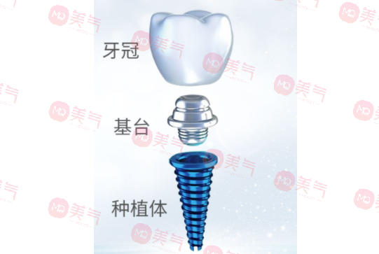 種植牙齒多少錢(qián)一顆2023？種植體品牌、醫(yī)生選擇都決定了定價(jià)！