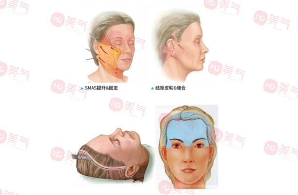 北京煤醫(yī)王馳拉皮手術(shù)多少錢？醫(yī)生技術(shù)介紹+價格表參考