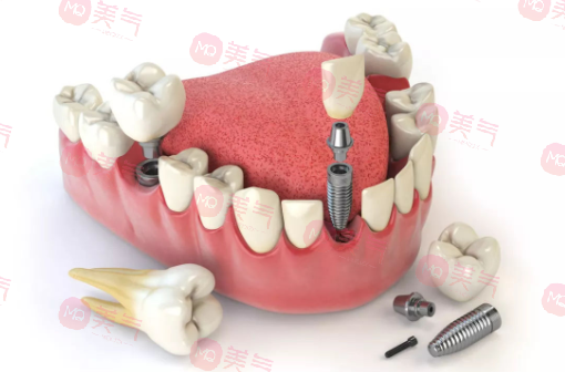 北京種植牙多少錢一顆？?jī)r(jià)格費(fèi)用_注意事項(xiàng)_使用年限