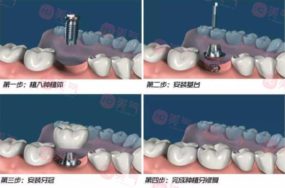 北京種植牙多少錢一顆？價(jià)格費(fèi)用_注意事項(xiàng)_使用年限