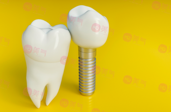 上海種植牙價(jià)格表大全更新！低至5900？內(nèi)附種植牙原理、注意事項(xiàng)