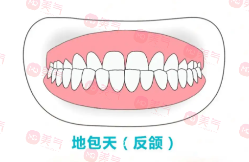 地包天矯正需要多少費用？骨性地包天整形費用2-4萬起