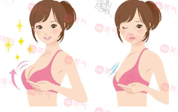 重慶豐胸得多錢？2萬的曼托假體隆胸要不要做