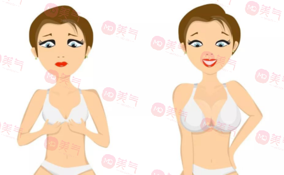 重慶豐胸得多錢？2萬的曼托假體隆胸要不要做