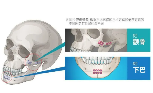 上海李志海和柴崗顴骨顴弓術(shù)手術(shù)費(fèi)用分別是多少？