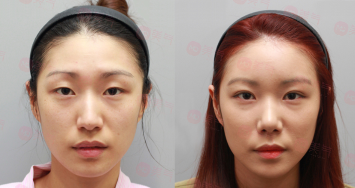 開眼角費(fèi)用大概需要多少錢？