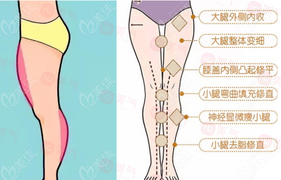 臀部吸脂手術(shù)優(yōu)點(diǎn)、作用、注意事項(xiàng)介紹