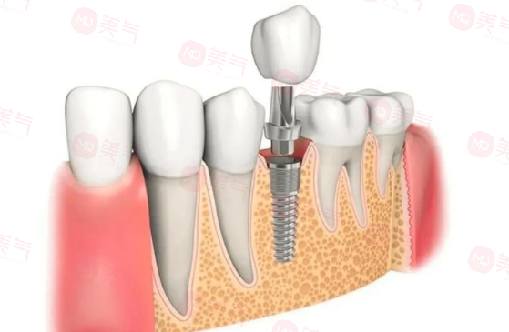 北京種牙多少錢一顆啊2024價格表，北京好的口腔醫(yī)院推薦