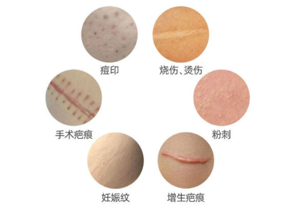 祛疤痕
