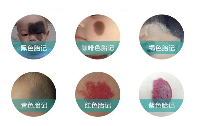 去色素&胎記
