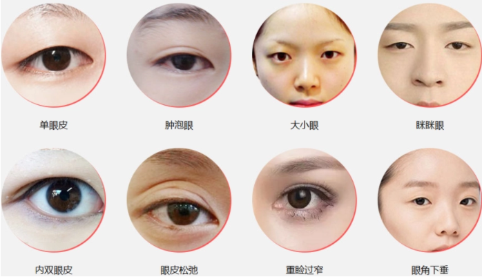 眼瞼整形