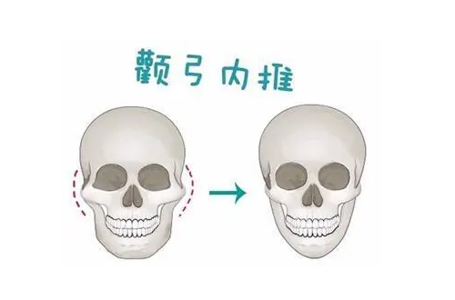 顴骨內(nèi)推