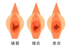 處女膜修復(fù)